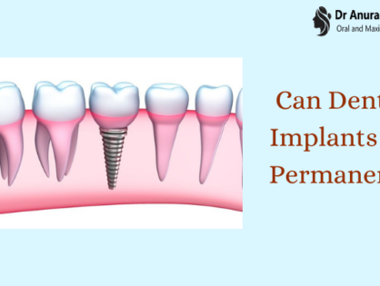 Can Dental Implants Be Permanent?