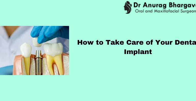 How to Take Care of Your Dental Implant ?