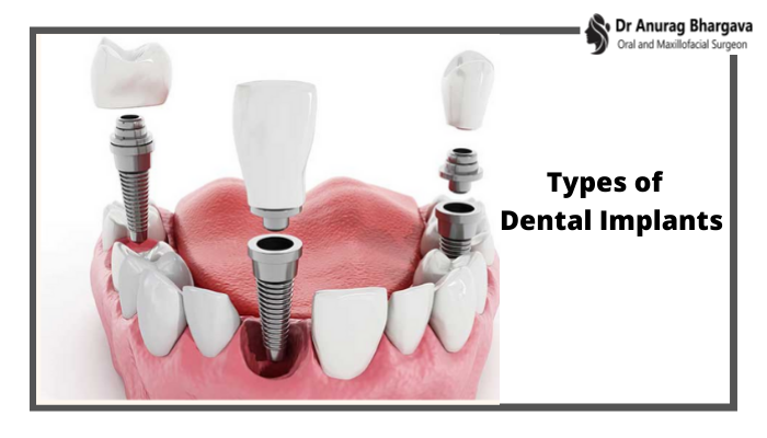 What are the Types of Dental Implants? Why are they Used?