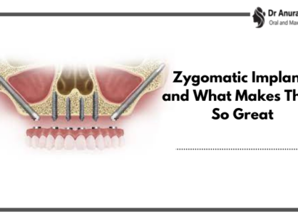 Zygomatic Implants and What Makes Them So Great