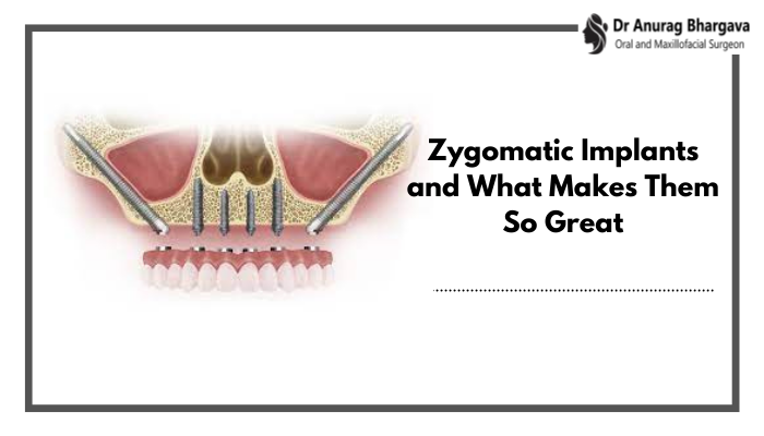 Zygomatic Implants and What Makes Them So Great