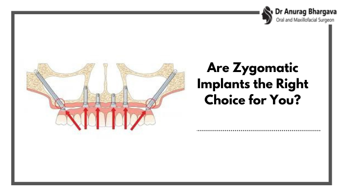 Are Zygomatic Implants the Right Choice for You?