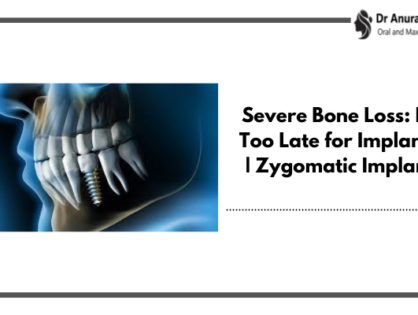 Severe Bone Loss: Is it Too Late for Implants? | Zygomatic Implants