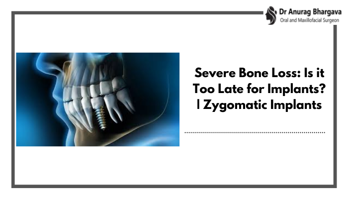Severe Bone Loss: Is it Too Late for Implants? | Zygomatic Implants