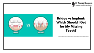 Bridge vs Implant