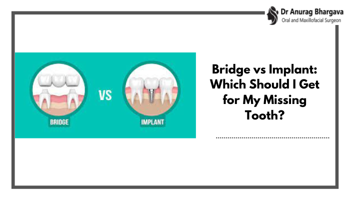 Bridge vs Implant: Which Should I Get for My Missing Tooth?