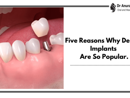 Five Reasons Why Dental Implants Surgery Is So Popular