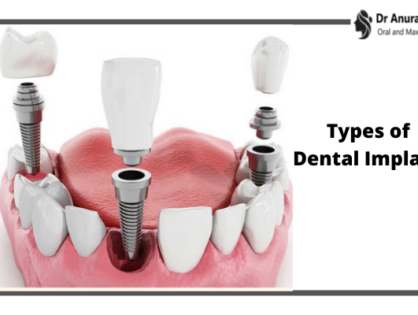 Exploring the Different Types of Dental Implants