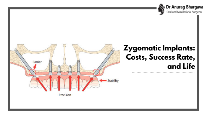 Zygomatic Implants: The Guide to a Permanent Smile