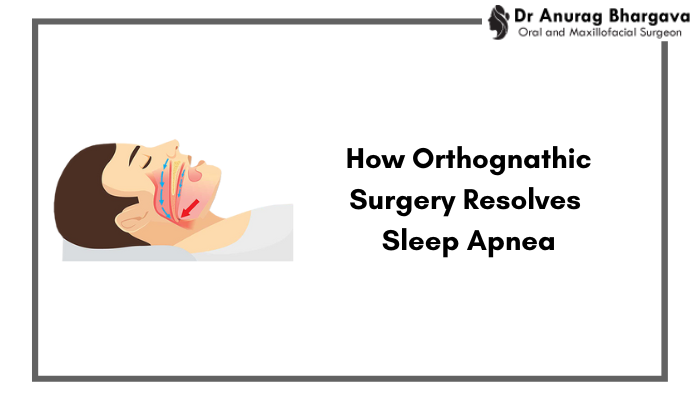 How Orthognathic Surgery Treats Sleep Apnea