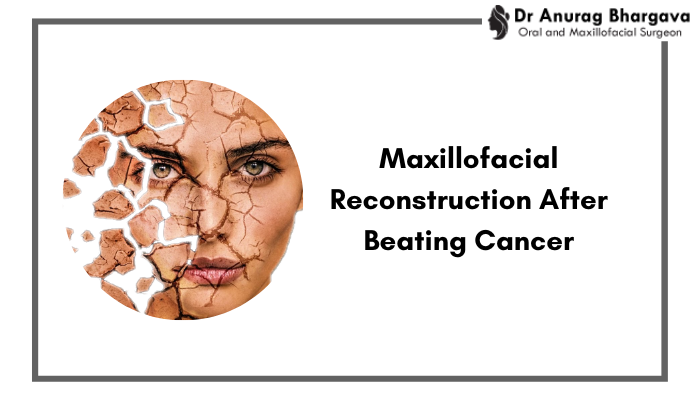 Maxillofacial Reconstruction After Beating Cancer | Restoring Hope