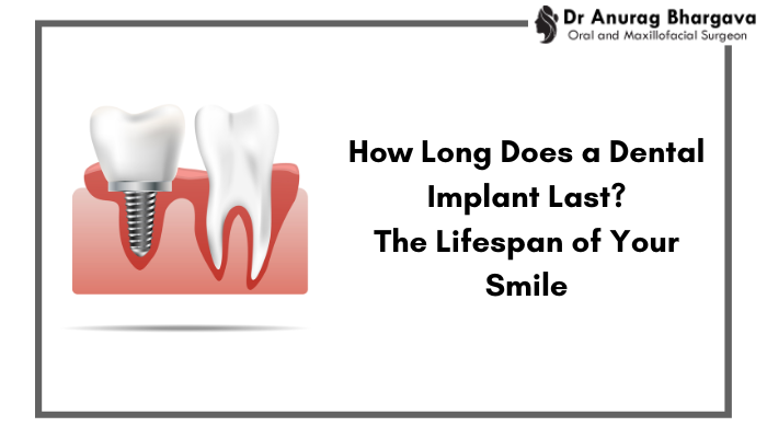 How Long Does a Dental Implant Last? Lifespan of Your Smile