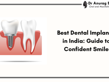 Best Dental Implants in India: Your Guide to a Confident Smile