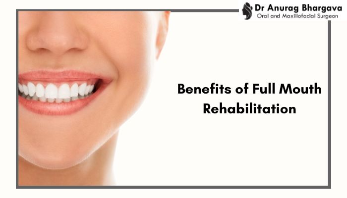 Benefits of Full Mouth Rehabilitation: Beyond Just a Beautiful Smile