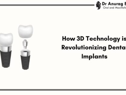 How 3D Technology is Revolutionizing Dental Implants