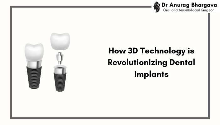 How 3D Technology is Revolutionizing Dental Implants