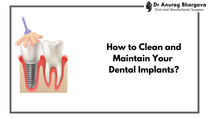 Clean and Maintain Your Dental Implants by Dr Anurag Bhargava