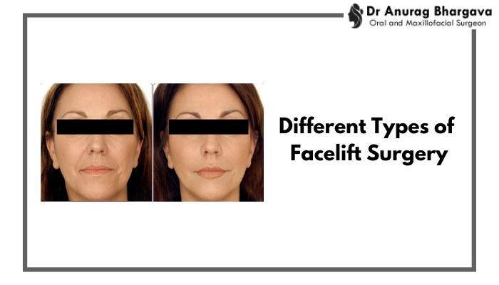 Different Types of Facelift Surgery: Which One Is Right for You?