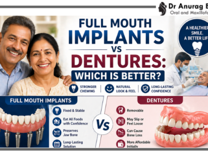 Full Mouth Implants vs Dentures: Which Is Better?