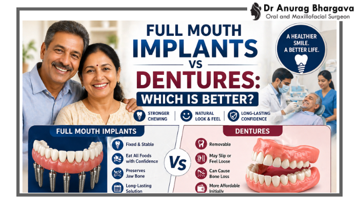 Full Mouth Implants vs Dentures: Which Is Better?