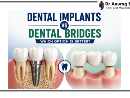 Dental Implants vs Dental Bridges – Which Option Is Better?