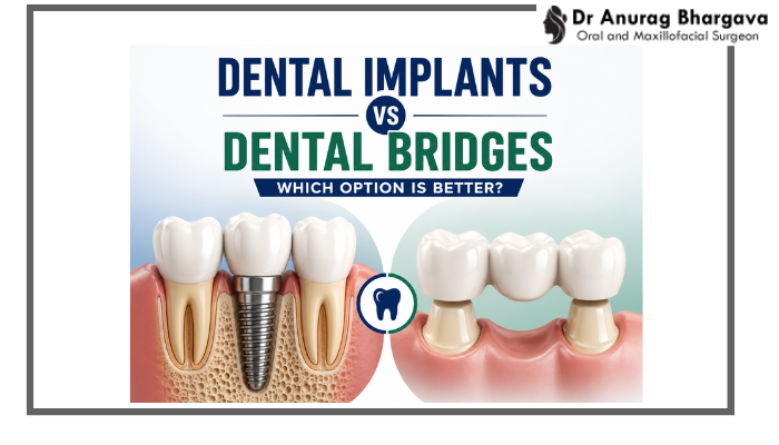 Dental Implants vs Dental Bridges – Which Option Is Better?